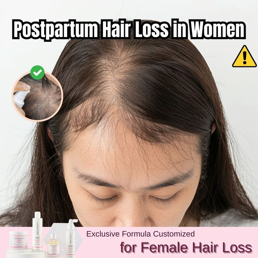 Postpartum Hair Loss in Women Is a Quite Common Phenomenon